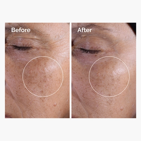 The Ordinary - Glycolic Acid 7% Exfoliating Toner - Tonikas su 7% Glikolio Rūgštimi - 100ml