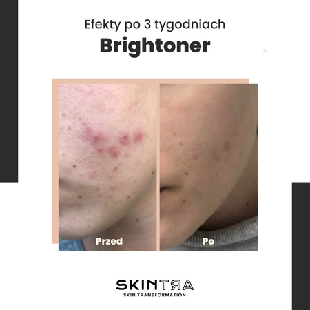 SkinTra - Brightoner - Visus Metus Naudojamas Rūgštinis Tonikas 9% - 100ml